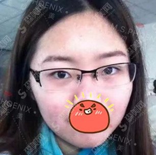 温志刚医生怎么样？技术实力怎么样+双眼皮案例果图展示