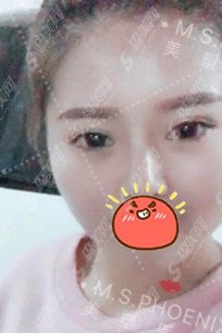 温志刚医生怎么样？技术实力怎么样+双眼皮案例果图展示