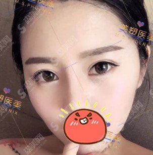 温志刚医生怎么样？技术实力怎么样+双眼皮案例果图展示