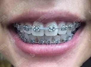 深圳阳光口腔门诊部口碑好不好？医院概述/医生实力介绍/牙齿矫正手术果