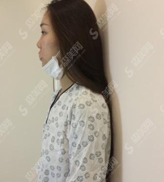 丰胸的价格?附丰胸案例+前后果对比图