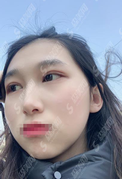 沈阳陆军总院美容整形科怎么样?沈阳陆军总院美容科做的双眼皮怎么样?附医院介绍及案例分享