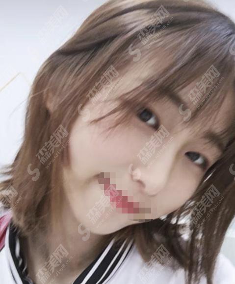 沈阳陆军总院美容整形科怎么样?沈阳陆军总院美容科做的双眼皮怎么样?附医院介绍及案例分享