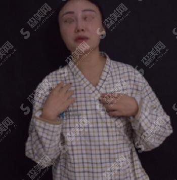 隆胸的价格?附隆胸案例+前后果对比图