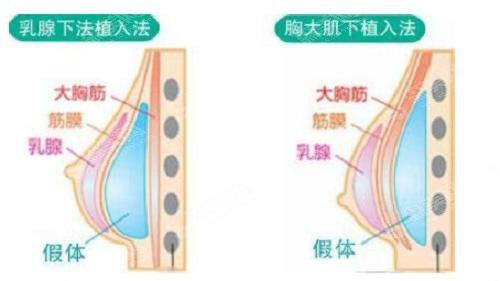 隆胸的价格?附隆胸案例+前后果对比图