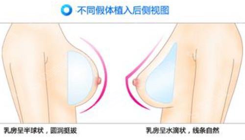 隆胸的价格?附隆胸案例+前后果对比图