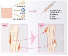 注射隆胸的价格?附注射隆胸案例+前后果对比图