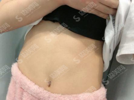 上海九院抽脂手术多少钱?附抽脂手术整形案例+术前术后果对比图