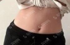 武汉三医院整形科怎么样？附武汉三医院整形科医院简介及整形手术成功案例分享