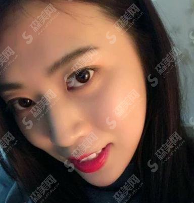 北医三院价目表2021，内含毕洪森医生面部除皱案例果图