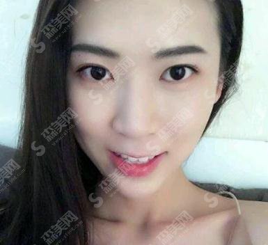 北医三院价目表2021，内含毕洪森医生面部除皱案例果图