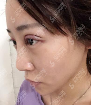 张余光整形医生切开双眼皮做得如何？上海第九人民医院整形外科/口碑好吗/案例展示
