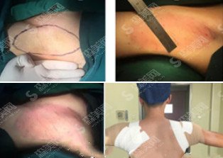 山东大学齐鲁医院整形科,齐鲁医院医生实力/腋臭去除的治疗果?内含医院较新价目表