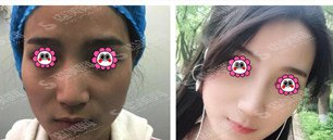 北京壹加壹整形医院价格表2021,隆鼻整形果怎么样？内附较新的壹加壹隆鼻价目表