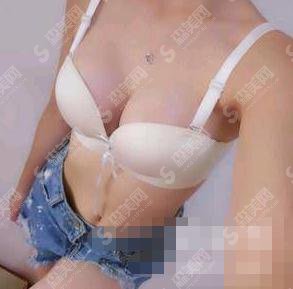 整形专家陈育哲隆胸技术好不好?深圳铭医医疗美容整形医院/口碑如何/隆胸案例