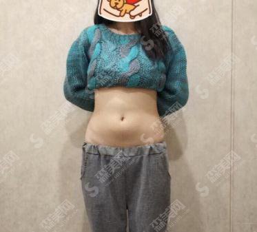 中国人民解放军烧伤整形外科价目表，2021内含李翰林吸脂瘦腰腹案例果对比图