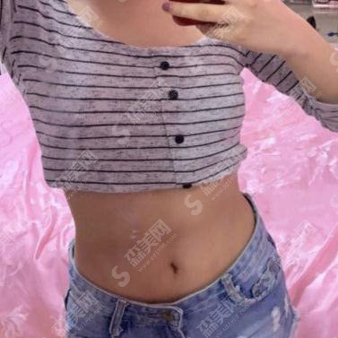 中国人民解放军烧伤整形外科价目表，2021内含李翰林吸脂瘦腰腹案例果对比图