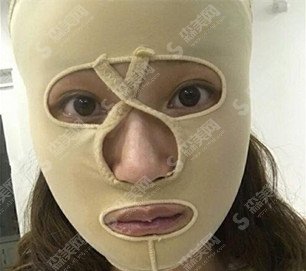 女性尖下颌角整形价目表2020,下颌角整形果恢复过程图分享