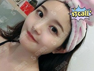 女性尖下颌角整形价目表2020,下颌角整形果恢复过程图分享