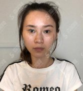 北京协和医院整形美容科价目表2021，内含龙笑医生疤痕修复案例