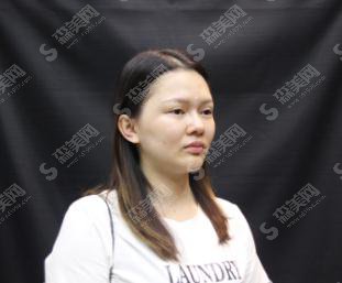 整形专家张海林自体脂肪全脸填充果好吗?内含填充案例果对比图