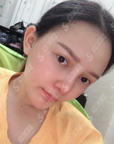 整形专家张海林自体脂肪全脸填充果好吗?内含填充案例果对比图