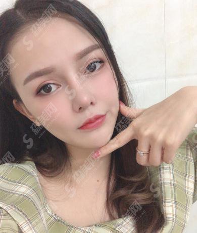 整形专家张海林自体脂肪全脸填充果好吗?内含填充案例果对比图