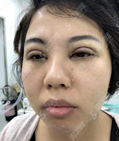 北京丽都医疗美容医院价目表2021，内含切开双眼皮案例果前后对比图