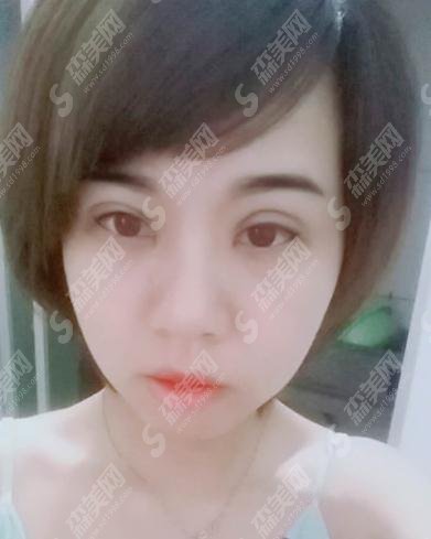 北京丽都医疗美容医院价目表2021，内含切开双眼皮案例果前后对比图