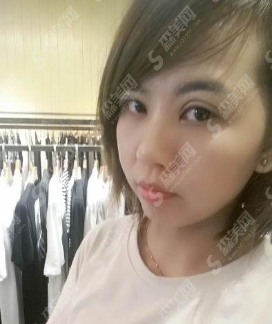 北京丽都医疗美容医院价目表2021，内含切开双眼皮案例果前后对比图