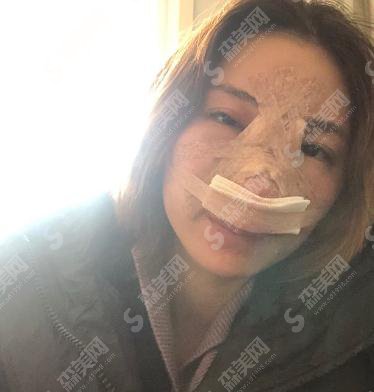 整形专家王友彬鼻部手术技术如何?北京协和医院整形美容外科/口碑好不好/鼻部手术案例