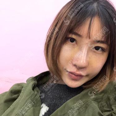 整形专家王友彬鼻部手术技术如何?北京协和医院整形美容外科/口碑好不好/鼻部手术案例
