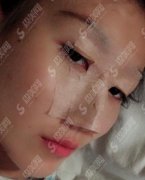 北京叶子整形美容医院价目表2021，内含鼻部手术案例前后对比图