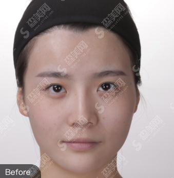 整形专家赵润蕾玻尿酸注射项目技术如何?北医三院整形科/个人简介/案例展示