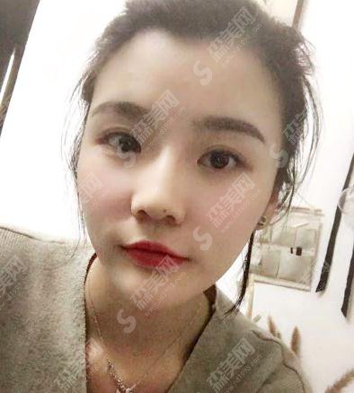 整形专家赵润蕾玻尿酸注射项目技术如何?北医三院整形科/个人简介/案例展示