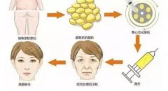 面部填充一般多少钱？面部填充的果可以保持多久呢？