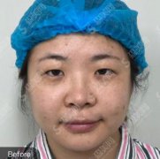 广州华美整形美容医院项目表2021，内含切割双眼皮案例图对比