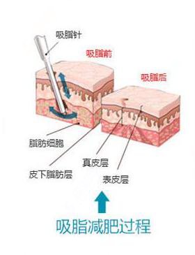 吸脂价格多少？吸脂有哪些方法呢？