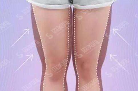 吸脂价格多少？吸脂有哪些方法呢？