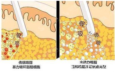 吸脂价格多少？吸脂有哪些方法呢？