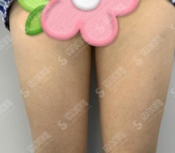 整形专家王永前吸脂技术如何?北京南家整形医院/口碑好吗/案例展示