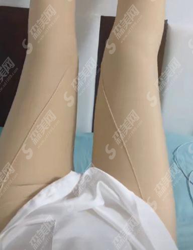 整形专家王永前吸脂技术如何?北京南家整形医院/口碑好吗/案例展示