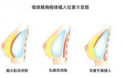 假体隆胸价格？假体隆胸的优势在哪？