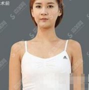 上海华美整形医院价目表2021，妙桃丰胸价格？内含丰胸案例前后对比图