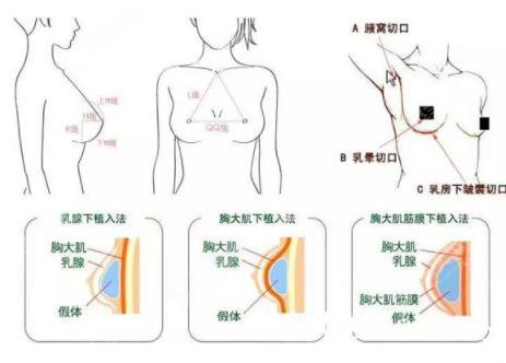 假体隆胸的价格?附假体隆胸案例+前后果对比图