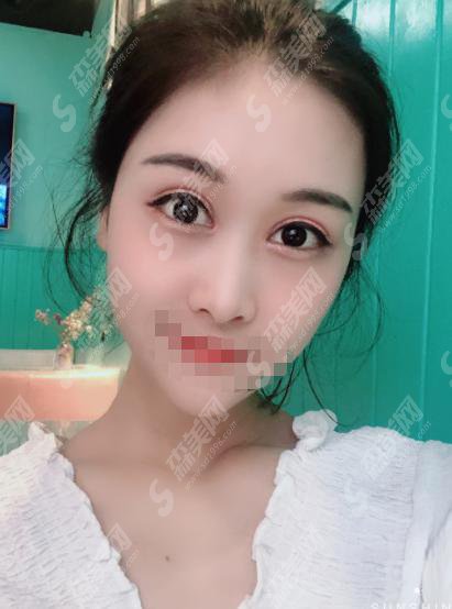 西京医院整形科怎么样西京医院整形科做的双眼皮怎么样？附医师介绍及案例分享