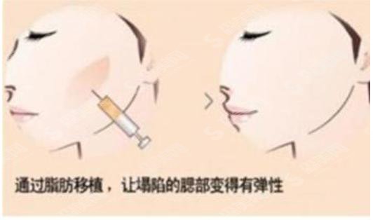 面部填充需要多少钱？附面部填充案例+前后果对比图