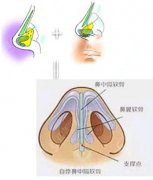 隆鼻耳软骨手术的价格?附隆鼻耳软骨手术案例+前后果对比图
