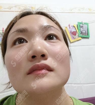 四川华美整形美容医院价目表2021，面部除皱费用？内含面部除皱案例果