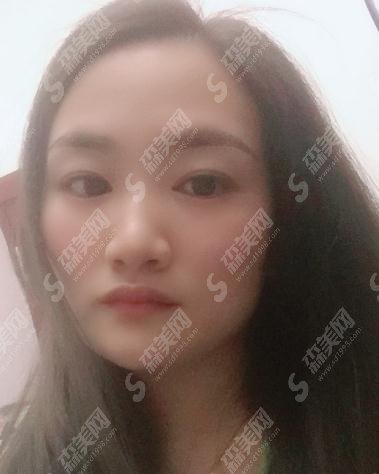 四川华美整形美容医院价目表2021，面部除皱费用？内含面部除皱案例果